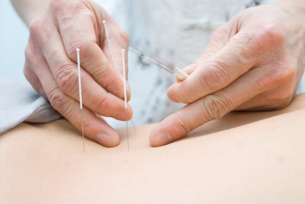Acupuncture